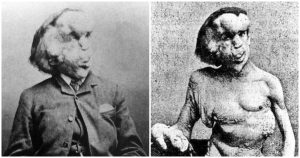 The Heartbreaking Story Of Joseph Merrick, The Elephant Man, Who Sought Normal Life